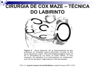 CIRURGIA DE COX MAZE – TÉCNICA
DO LABIRINTO

COX, J.L. Surgical treatment of atrial fibrillation: a review Europace 2004 5, 20-29.

 