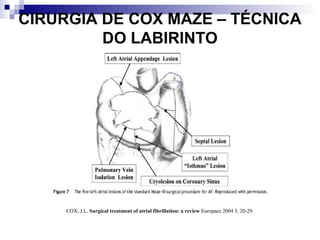 CIRURGIA DE COX MAZE – TÉCNICA
DO LABIRINTO

COX, J.L. Surgical treatment of atrial fibrillation: a review Europace 2004 5, 20-29.

 