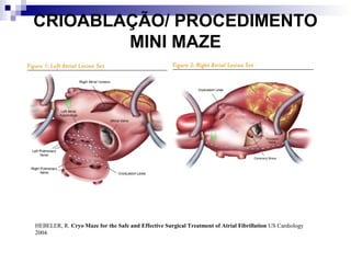 CRIOABLAÇÃO/ PROCEDIMENTO
MINI MAZE

HEBELER, R. Cryo Maze for the Safe and Effective Surgical Treatment of Atrial Fibrillation US Cardiology
2004.

 