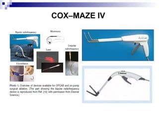 COX–MAZE IV

 