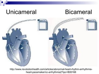 Unicameral

Bicameral

http://www.revolutionhealth.com/articles/abnormal-heart-rhythm-arrhythmiaheart-pacemaker/cc-arrhythmia2?ipc=B00168

 