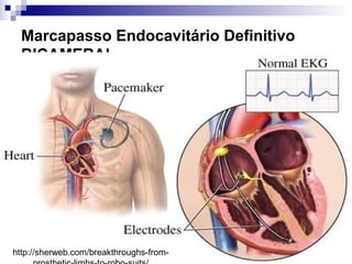 Marcapasso Endocavitário Definitivo
BICAMERAL

http://sherweb.com/breakthroughs-from-

 