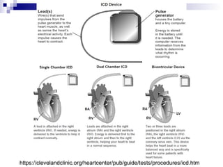 https://clevelandclinic.org/heartcenter/pub/guide/tests/procedures/icd.htm

 