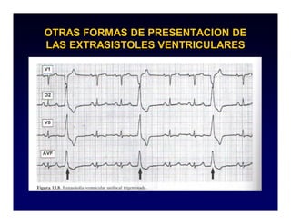 OTRAS FORMAS DE PRESENTACION DE
LAS EXTRASISTOLES VENTRICULARES
 