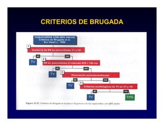 CRITERIOS DE BRUGADA
 