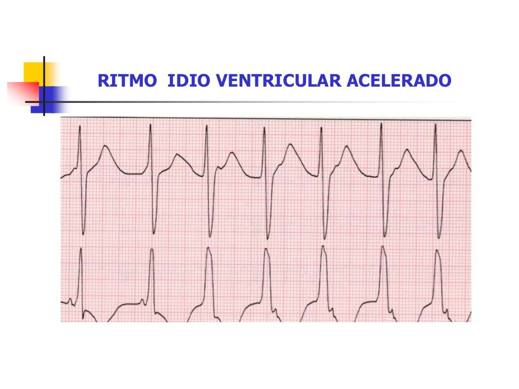 Arritmias ventriculares 2 dr jorge
