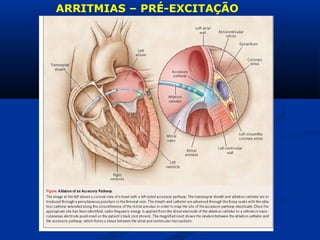 ARRITMIAS – PRÉ-EXCITAÇÃO 
 