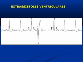 EXTRASSÍSTOLES VENTRICULARES 
 