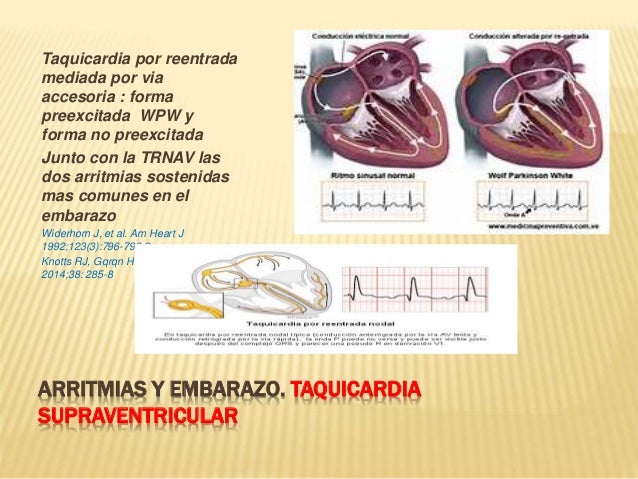 Arritmias Y Embarazo