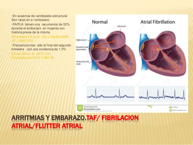 Arritmias Y Embarazo