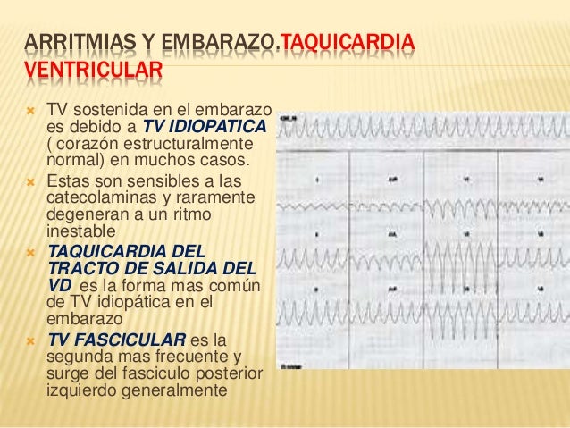 Arritmias Y Embarazo