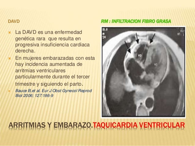 Arritmias Y Embarazo