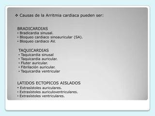  Bloqueo cardiaco sinoauricular (SA).