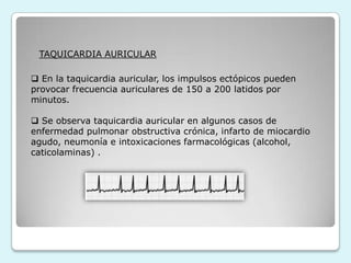 Taquicardia ventricularLATIDOS ECTOPICOS AISLADOSExtrasístoles auriculares.
