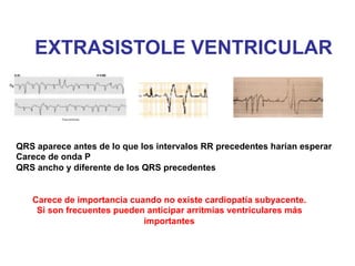 EXTRASISTOLE VENTRICULAR 
QRS aparece antes de lo que los intervalos RR precedentes harían esperar 
Carece de onda P 
QRS ancho y diferente de los QRS precedentes 
Carece de importancia cuando no existe cardiopatía subyacente. 
Si son frecuentes pueden anticipar arritmias ventriculares más 
importantes 
 