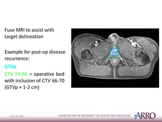 ARROCase_Urethral cancer and it's treatment.pptx
