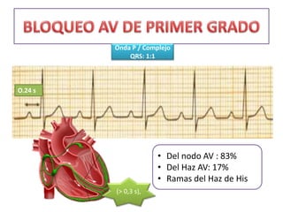 O.24 s
• Del nodo AV : 83%
• Del Haz AV: 17%
• Ramas del Haz de His
Onda P / Complejo
QRS: 1:1
(> 0,3 s),
 