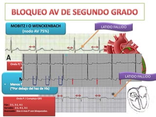 LATIDO FALLIDO
Onda P/ Complejo QRS
4:3,3:2
MOBITZ II
MOBITZ I O WENCKENBACH
(nodo AV 75%)
 