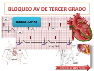 Síndrome de Stoke-Adams
 