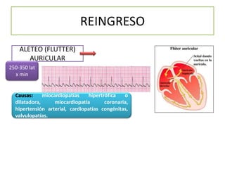 REINGRESO
ALETEO (FLUTTER)
AURICULAR
250-350 lat
x min
Causas: miocardiopatías hipertrófica o
dilatadora, miocardiopatía coronaria,
hipertensión arterial, cardiopatías congénitas,
valvulopatías.
 
