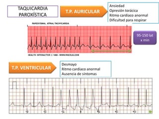TAQUICARDIA
PAROXÍSTICA
T.P. AURICULAR
Ansiedad
Opresión torácica
Ritmo cardíaco anormal
Dificultad para respirar
T.P. VENTRICULAR
Desmayo
Ritmo cardíaco anormal
Ausencia de síntomas
95-150 lat
x min
 