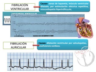 FIBRILACIÓN
VENTRICULAR
Causas: zonas de isquemia, músculo ventricular
dilatado, por estimulación eléctrica repetitiva,
miocardiopatía hipertrófica,etc.
FIBRILACIÓN
AURICULAR
Causas: dilatación ventricular por valvulopatías,
insuficiencia cardíaca.
 