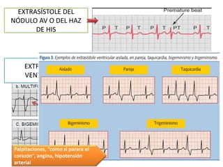 EXTRASÍSTOLE DEL
NÓDULO AV O DEL HAZ
DE HIS
EXTRASÍSTOLE
VENTRICULAR
Palpitaciones, “como si parara el
corazón”, angina, hipotensión
arterial
 