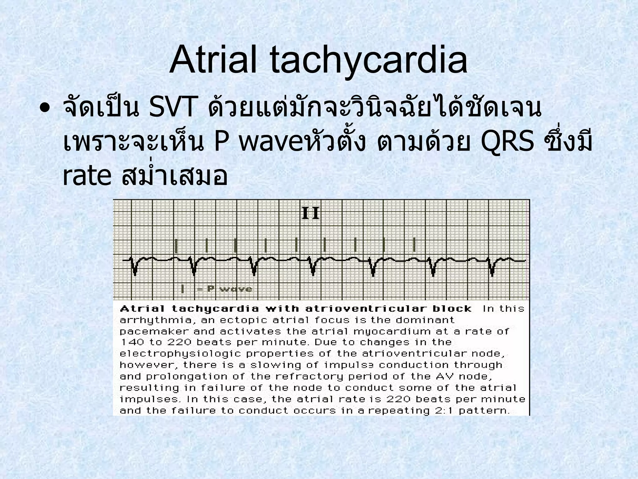 Atrial tachycardia จัดเป็น  SVT  ด้วยแต่มักจะวินิจฉัยได้ชัดเจนเพราะจะเห็น  P wave หัวตั้ง ตามด้วย   QRS  ซึ่งมี  rate  สมํ่าเสมอ 