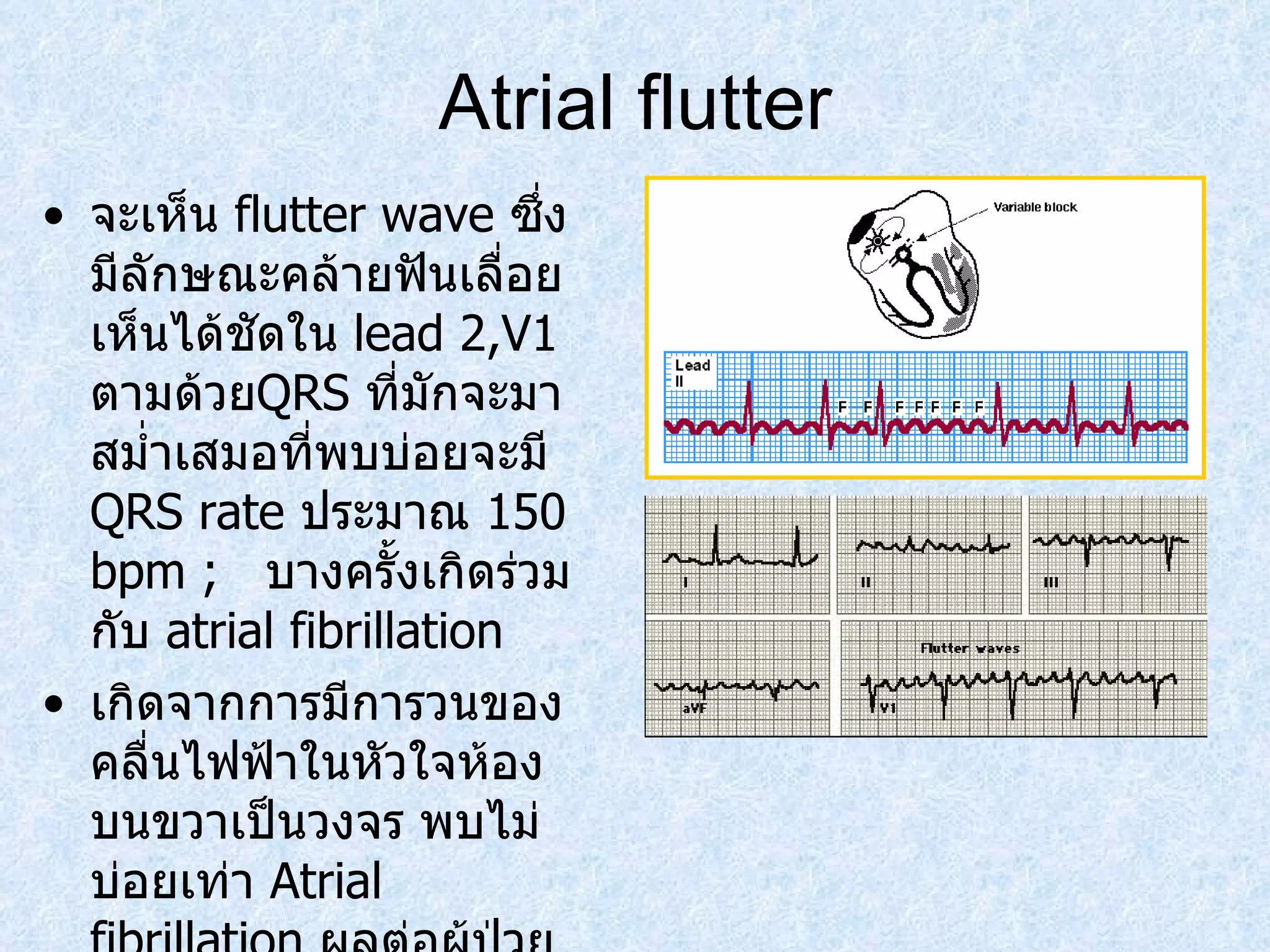 Atrial flutter จะเห็น  flutter wave  ซึ่งมีลักษณะคล้ายฟันเลื่อยเห็นได้ชัดใน  lead 2,V1  ตามด้วย QRS  ที่มักจะมาสมํ่าเสมอที่พบบ่อยจะมี  QRS rate  ประมาณ  150 bpm ;  บางครั้งเกิดร่วมกับ  atrial fibrillation เกิดจากการมีการวนของคลื่นไฟฟ้าในหัวใจห้องบนขวาเป็นวงจร พบไม่บ่อยเท่า  Atrial fibrillation  ผลต่อผู้ป่วยคล้ายคลึงกับ  Atrial fibrillation 