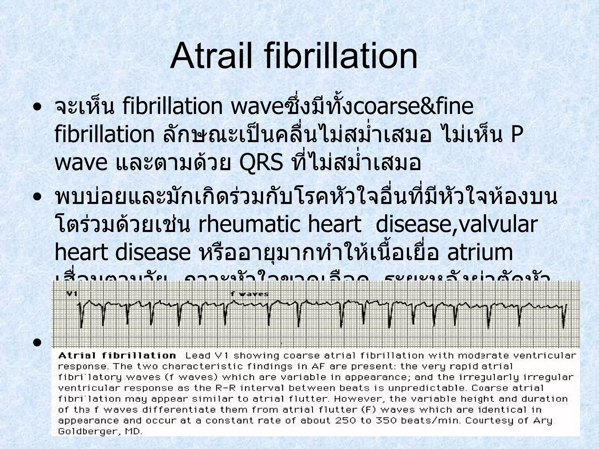Atrail fibrillation  จะเห็น  fibrillation wave ซึ่งมีทั้ง coarse&fine fibrillation  ลักษณะเป็นคลื่นไม่สมํ่าเสมอ ไม่เห็น  P wave  และตามด้วย  QRS  ที่ไม่สมํ่าเสมอ  พบบ่อยและมักเกิดร่วมกับโรคหัวใจอื่นที่มีหัวใจห้องบนโตร่วมด้วยเช่น  rheumatic hear t  disease,valvular heart disease  หรืออายุมากทำให้เนื้อเยื่อ  atrium  เสื่อมตามวัย ,  ภาวะหัวใจขาดเลือด ,  ระยะหลังผ่าตัดหัวใจใหม่ๆ จะมีอาการใจสั่น พลิ้ว ถ้ามีอัตราเร็วมากอาจรุนแรงถึงหมดสติได้ 
