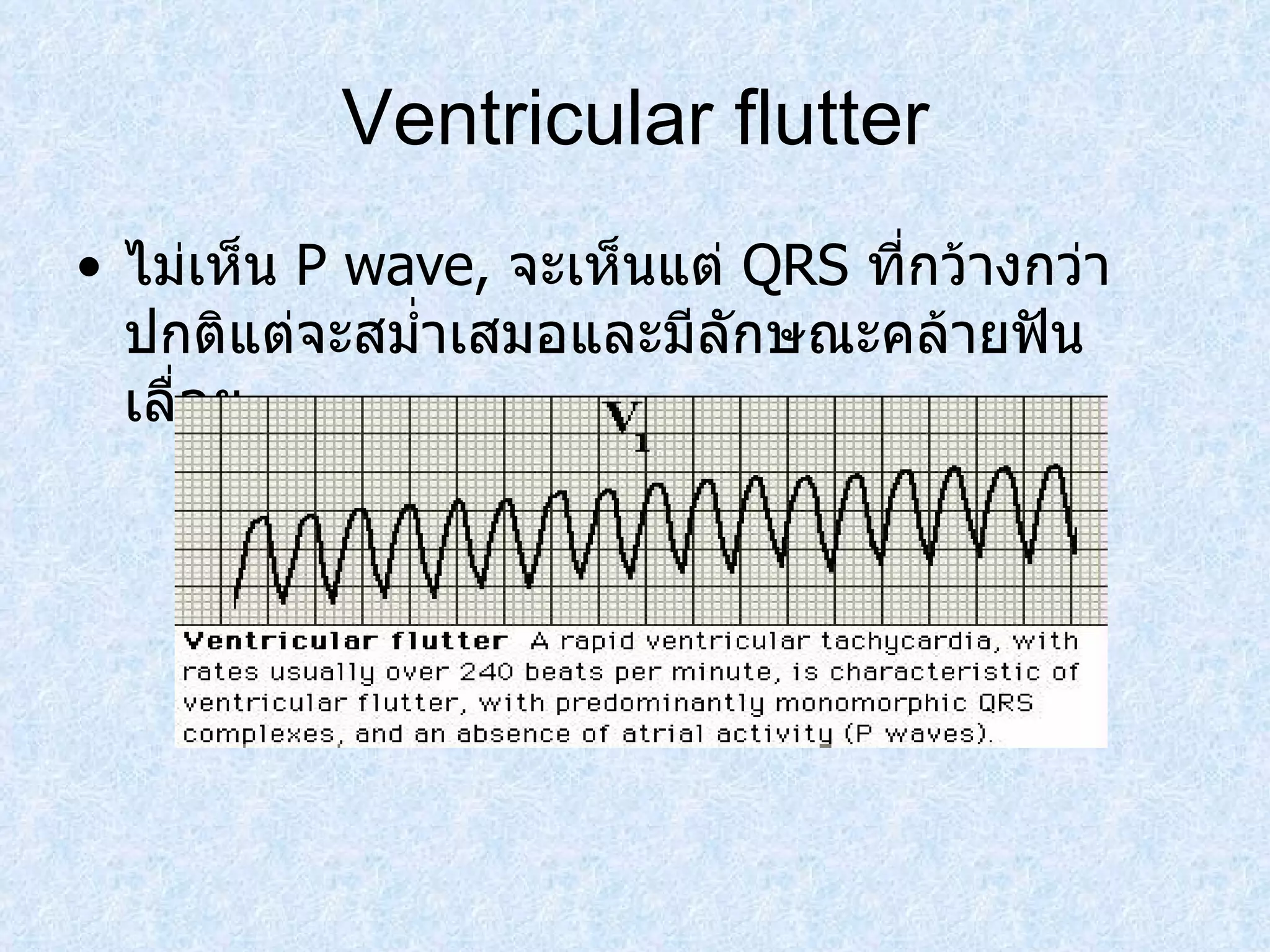 Ventricular flutter ไม่เห็น  P wave,  จะเห็นแต่  QRS  ที่กว้างกว่าปกติแต่จะสมํ่าเสมอและมีลักษณะคล้ายฟันเลื่อย 