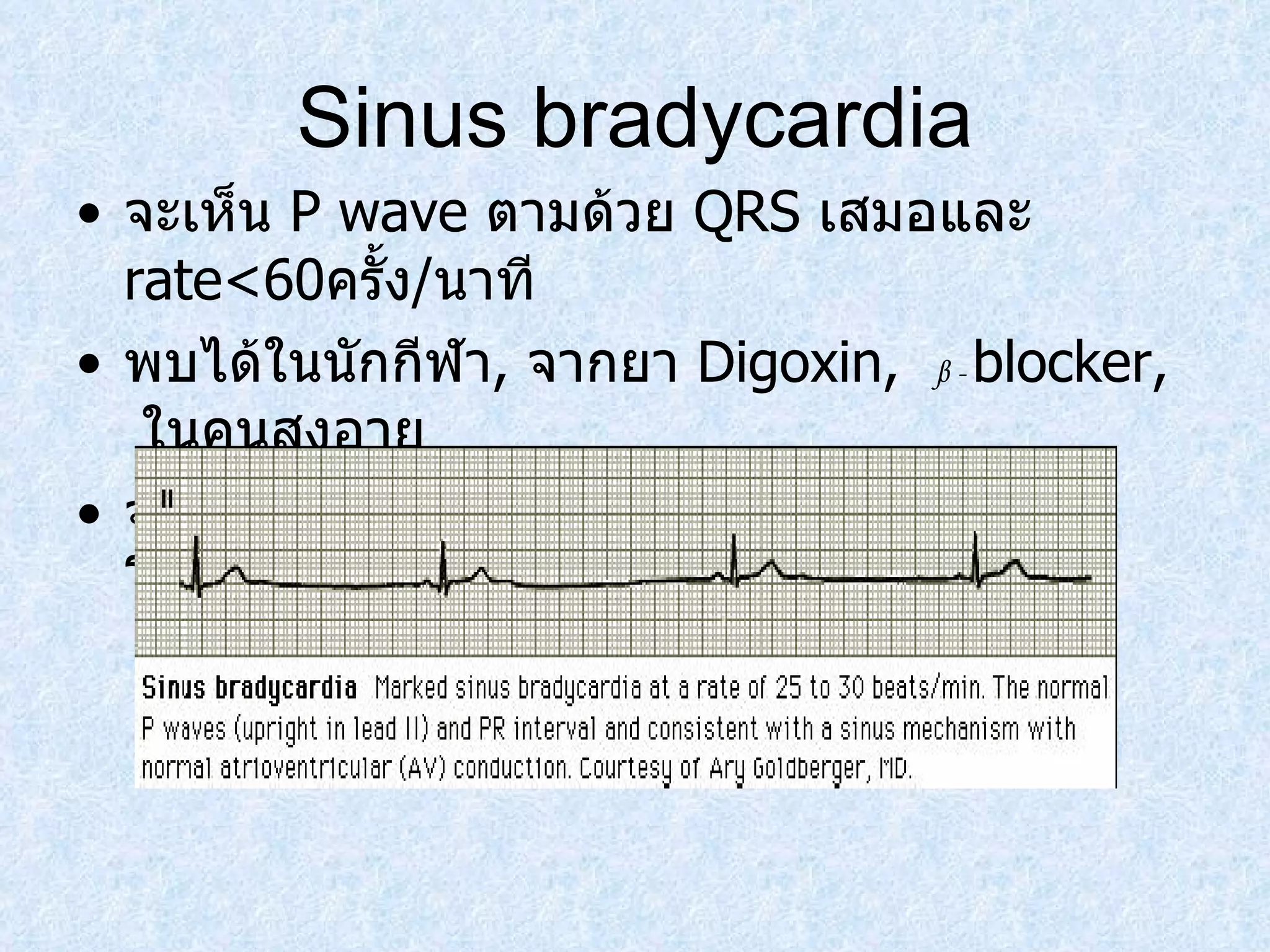 Sinus bradycardia จะเห็น  P wave  ตามด้วย  QRS  เสมอและ  rate<60 ครั้ง / นาที พบได้ในนักกีฬา ,   จากยา  Digoxin,  β  -  blocker,   ในคนสูงอายุ จะมีอาการหน้ามืด เป็นลม มึนงง ความดันโลหิตต่ำ 
