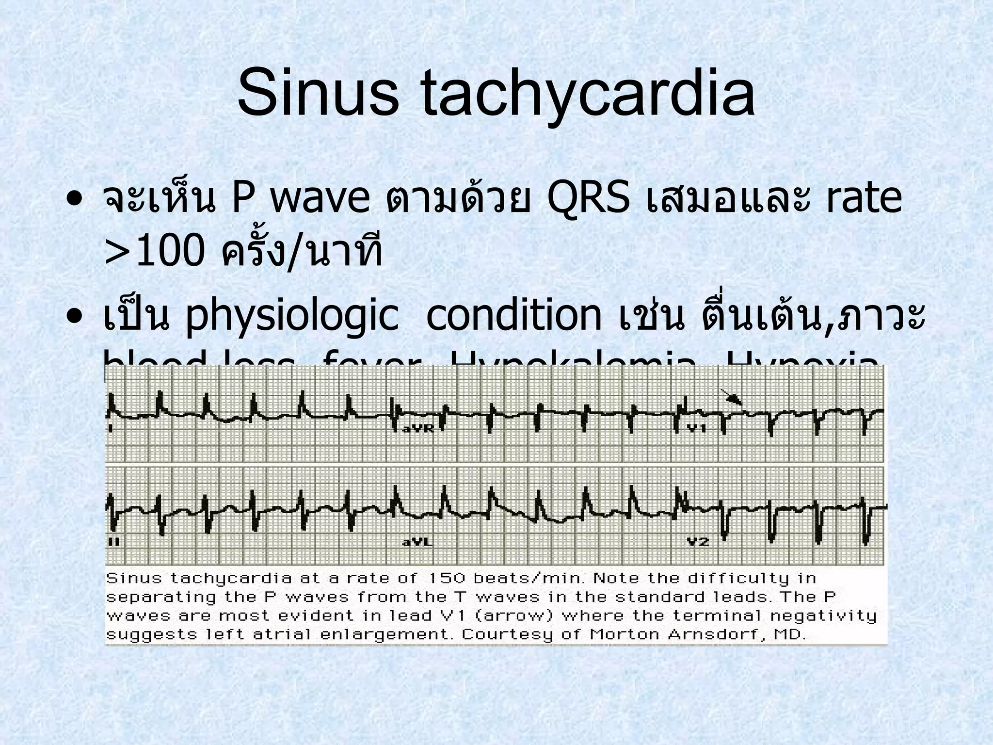 Sinus tachycardia จะเห็น  P wave  ตามด้วย  QRS  เสมอและ  rate  >100  ครั้ง / นาที เป็น  physiologic  condition  เช่น ตื่นเต้น , ภาวะ  blood loss, fever ,   Hypokalemia, Hypoxia 