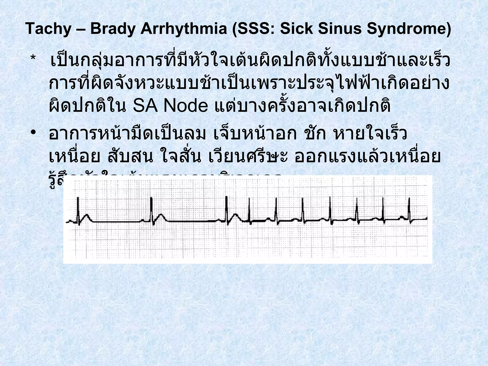 *  เป็นกลุ่มอาการที่มีหัวใจเต้นผิดปกติทั้งแบบช้าและเร็ว การที่ผิดจังหวะแบบช้าเป็นเพราะประจุไฟฟ้าเกิดอย่างผิดปกติใน  SA Node  แต่บางครั้งอาจเกิดปกติ อาการหน้ามืดเป็นลม เจ็บหน้าอก ชัก หายใจเร็ว เหนื่อย สับสน ใจสั่น เวียนศรีษะ ออกแรงแล้วเหนื่อย รู้สึกหัวใจเต้นแรงแถวบริเวณคอ Tachy – Brady Arrhythmia  ( SSS: Sick Sinus Syndrome ) 