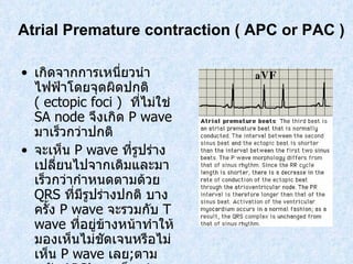 Atrial Premature contraction   ( APC or PAC ) เกิดจากการเหนี่ยวนำไฟฟ้าโดยจุดผิดปกติ  ( ectopic foci )  ที่ไม่ใช่  SA node  จึงเกิด  P wave  มาเร็วกว่าปกติ จะเห็น  P wave  ที่รูปร่างเปลี่ยนไปจากเดิมและมาเร็วกว่ากําหนดตามด้วย  QRS  ที่มีรูปร่างปกติ บางครั้ง  P wave  จะรวมกับ  T wave  ที่อยู่ข้างหน้าทําให้มองเห็นไม่ชัดเจนหรือไม่เห็น  P wave  เลย ; ตามหลัง  APC’s  จะเห็น  sinus  มาช้ากว่าปกติเรียกว่ามี  incomplete compensatory pause 