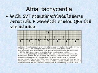 Atrial tachycardia จัดเป็น  SVT  ด้วยแต่มักจะวินิจฉัยได้ชัดเจนเพราะจะเห็น  P wave หัวตั้ง ตามด้วย   QRS  ซึ่งมี  rate  สมํ่าเสมอ 