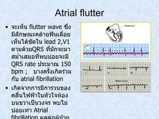 Atrial flutter จะเห็น  flutter wave  ซึ่งมีลักษณะคล้ายฟันเลื่อยเห็นได้ชัดใน  lead 2,V1  ตามด้วย QRS  ที่มักจะมาสมํ่าเสมอที่พบบ่อยจะมี  QRS rate  ประมาณ  150 bpm ;  บางครั้งเกิดร่วมกับ  atrial fibrillation เกิดจากการมีการวนของคลื่นไฟฟ้าในหัวใจห้องบนขวาเป็นวงจร พบไม่บ่อยเท่า  Atrial fibrillation  ผลต่อผู้ป่วยคล้ายคลึงกับ  Atrial fibrillation 