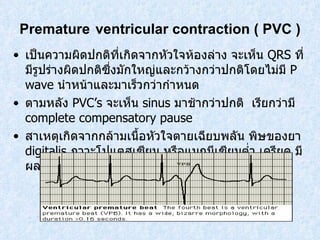 Premature   ventricular contraction  (  PVC ) เป็นความผิดปกติที่เกิดจากหัวใจห้องล่าง จะเห็น  QRS  ที่มีรูปร่างผิดปกติซึ่งมักใหญ่และกว้างกว่าปกติโดยไม่มี  P wave  นําหน้าและมาเร็วกว่ากําหนด ตามหลัง  PVC’s  จะเห็น  sinus  มาช้ากว่าปกติ  เรียกว่ามี  complete compensatory pause สาเหตุเกิดจากกล้ามเนื้อหัวใจตายเฉียบพลัน พิษของยา  digitalis  ภาวะโปแตสเซียม หรือแมกนีเซียมต่ำ เครียด มีผลทำให้เลือดออกจากหัวใจลดลง หน้ามืด เป็นลม  