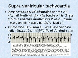Supra ventricular tachycardia เกิดจากการเต้นของหัวใจเร็วผิดปกติ มากกว่า  200  ครั้ง / นาที โดยมีจุดกำเนิดเหนือ  bundle of his  มี  rate  สมํ่าเสมอ แต่อาจจะเห็นหรือไม่เห็น  P wave (  ถ้าเห็น  P wave  มักจะมี  P wave  หัวกลับใน  lead 2 ) จะมีอาการเวียนศีรษะเล็กน้อย  กระสับส่าย วิตกกังวลจนถึง เจ็บแน่นหน้าอก ทำให้ใจสั่น หรือใจเต้นเร็ว และอาจหยุดได้ทันทีทันใด เนื่องจาก  cardiac output  ลดลง และเลือดไปเลี้ยงสมองลดลง และอาจเกิด  asystole  ได้ 