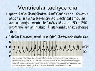 Ventricular tachycardia จุดกำเนิดไฟฟ้าอยู่ที่กล้ามเนื้อหัวใจห้องล่าง  ตำแหน่งเดียวกัน  และเกิด  Re-entry  ส่ง  Electrical Impulse  ออกมากระตุ้น  Ventricle  ในอัตราเร็วมาก  150 – 240  ครั้ง / นาที  และสม่ำเสมอ  ไม่สัมพันธ์กับการบีบตัวของ  atrium  ไม่เห็น  P wave,  จะเห็นแต่  QRS  ที่กว้างกว่าปกติแต่จะสมํ่าเสมอ มักมีอาการเจ้บหน้าอก ใจสั่น เป็นลม เนื่องจากเลือดไปเลี่ยงสมองไม่พอ ความดันโลหิตต่ำและหัวใจล้มเหลว พบบ่อยในผู้ป่วยโรคกล้ามเนื้อหัวใจขาดเลือด 