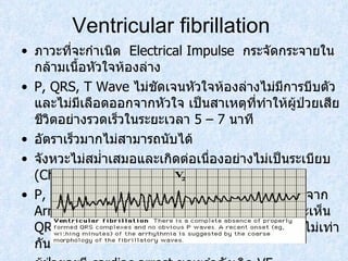 Ventricular fibrillation  ภาวะที่จะกำเนิด  Electrical Impulse  กระจัดกระจายในกล้ามเนื้อหัวใจห้องล่าง  P, QRS, T Wave  ไม่ชัดเจนหัวใจห้องล่างไม่มีการบีบตัวและไม่มีเลือดออกจากหัวใจ เป็นสาเหตุที่ทำให้ผู้ป่วยเสียชีวิตอย่างรวดเร็วในระยะเวลา  5 – 7  นาที อัตราเร็วมากไม่สามารถนับได้ จังหวะไม่สม่ำเสมอและเกิดต่อเนื่องอย่างไม่เป็นระเบียบ  (Chaotic) P, QRS, T Wave  ไม่มีลักษณะ  Complex  แตกต่างจาก  Arrhythmia  อื่นๆ โดยสิ้นเชิง   ไม่เห็น  P wave, จะเห็น  QRS  ที่กว้างกว่าปกติและมาไม่สมํ่าเสมอและสูงตํ่าไม่เท่ากัน ผู้ป่วยจะมี  cardiac arrest  ขณะกําลังเกิด  VF 
