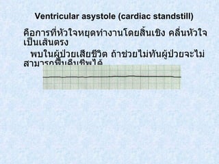 คือการที่หัวใจหยุดทำงานโดยสิ้นเชิง คลื่นหัวใจเป็นเส้นตรง  พบในผู้ป่วยเสียชีวิต ถ้าช่วยไม่ทันผู้ป่วยจะไม่สามารถฟื้นคืนชีพได้ Ventricular asystole (cardiac standstill) 