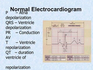 Normal Electrocardiogram   P  – Atria depolarization   QRS – Ventricle depolarization PR  – Conduction AV T  – Ventricle repolarization QT  – duration ventricle of    repolarization 