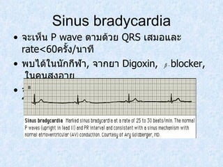 Sinus bradycardia จะเห็น  P wave  ตามด้วย  QRS  เสมอและ  rate<60 ครั้ง / นาที พบได้ในนักกีฬา ,   จากยา  Digoxin,  β  -  blocker,   ในคนสูงอายุ จะมีอาการหน้ามืด เป็นลม มึนงง ความดันโลหิตต่ำ 