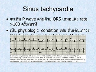 Sinus tachycardia จะเห็น  P wave  ตามด้วย  QRS  เสมอและ  rate  >100  ครั้ง / นาที เป็น  physiologic  condition  เช่น ตื่นเต้น , ภาวะ  blood loss, fever ,   Hypokalemia, Hypoxia 