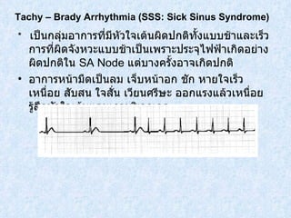 *  เป็นกลุ่มอาการที่มีหัวใจเต้นผิดปกติทั้งแบบช้าและเร็ว การที่ผิดจังหวะแบบช้าเป็นเพราะประจุไฟฟ้าเกิดอย่างผิดปกติใน  SA Node  แต่บางครั้งอาจเกิดปกติ อาการหน้ามืดเป็นลม เจ็บหน้าอก ชัก หายใจเร็ว เหนื่อย สับสน ใจสั่น เวียนศรีษะ ออกแรงแล้วเหนื่อย รู้สึกหัวใจเต้นแรงแถวบริเวณคอ Tachy – Brady Arrhythmia  ( SSS: Sick Sinus Syndrome ) 