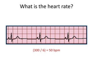 (300 / 6) = 50 bpm
What is the heart rate?
 