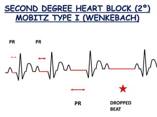 SECOND DEGREE HEART BLOCK (2º)
MOBITZ TYPE I (WENKEBACH)
PR PR
PR DROPPED
BEAT
 