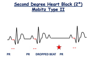 Second Degree Heart Block (2º)
Mobitz Type II
PR PR DROPPED BEAT PR
 