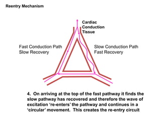 4. On arriving at the top of the fast pathway it finds the
slow pathway has recovered and therefore the wave of
excitation ‘re-enters’ the pathway and continues in a
‘circular’ movement. This creates the re-entry circuit
Fast Conduction Path
Slow Recovery
Slow Conduction Path
Fast Recovery
Cardiac
Conduction
Tissue
Reentry Mechanism
 